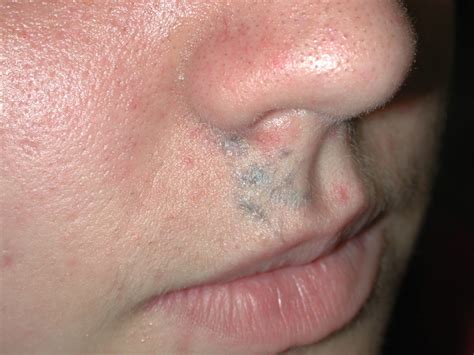 You risk cancer from anything, seriously if you've ever been to california even the tap water comes out of the faucet like Inflammatory Tattoo Reaction - Dermatology Advisor