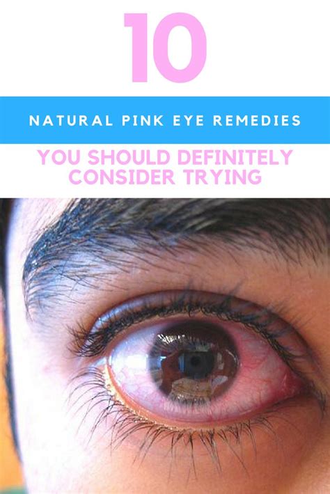 10 Natural Pink Eye Remedies That Really Work Pinkeye Remedies Pink
