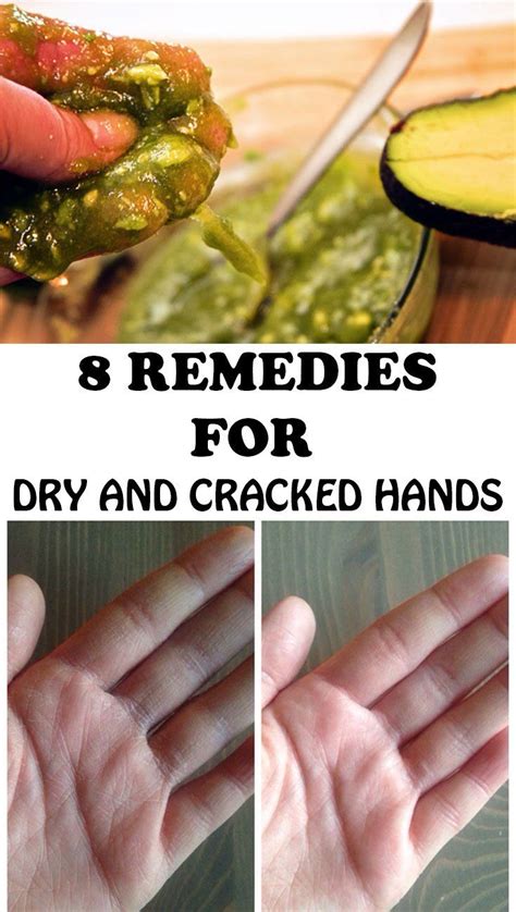 8 remedies for dry and cracked hands cracked hands dry hands remedy dry hands treatment