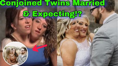 Everything To Know About Famous Conjoined Twins Abby And