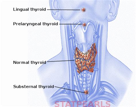 Figure Ectopic Thyroid Image Courtesy S Bhimji Md Statpearls