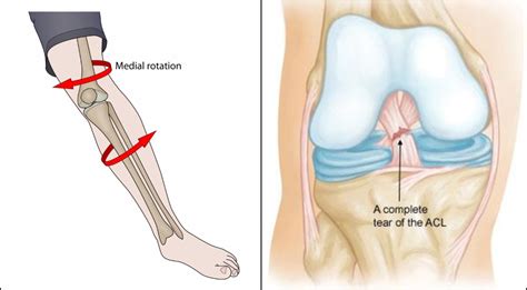 Anterior Cruciate Ligament Injury Motus Physical Therapy