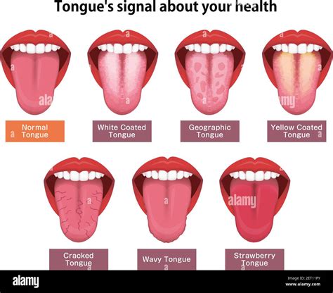 Healthy Tongue Pictures Vs Unhealthy