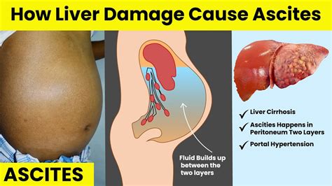 How Liver Damage Cause Ascites Hepatitis B Treatment Youtube