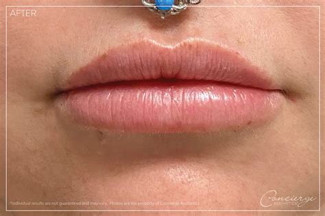 Before And After Juvederm Ultra Lips Yo Concierge Aesthetics