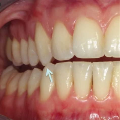 What Is Canine Guidance In Dentistry News Dentagama