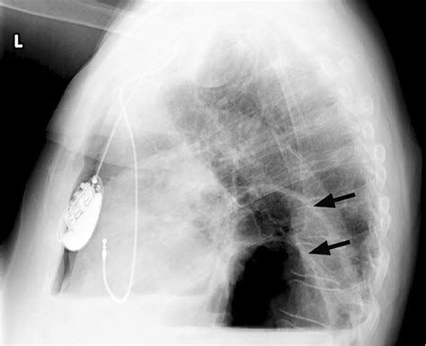 Chest Radiograph Lateral View Shows 2 Air Fluid Levels And A Large
