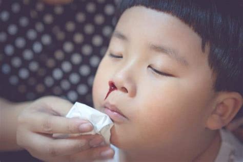 Nosebleeds In Children Everything You Need To Know Kids Clinic Singapore