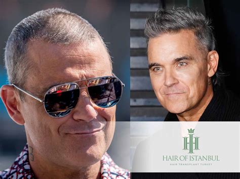 Robbie Williams Hair Transplant Chart Topping Hairline