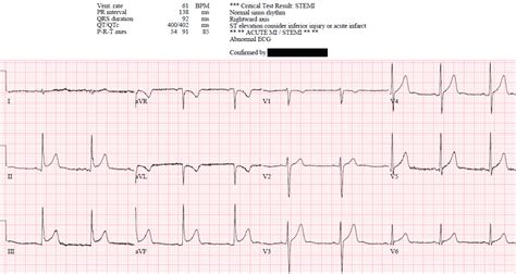 Dr Smiths Ecg Blog Inferior St Elevation With Reciprocal Change