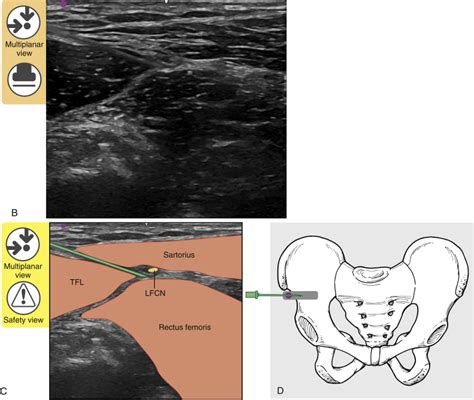 Lateral Femoral Cutaneous Nerve Injection Ultrasound Guidance