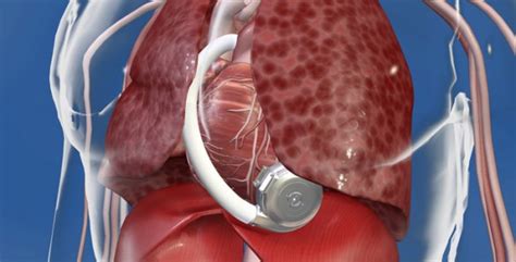 New Heart Pump Allows Minimally Invasive Approach Vanderbilt News Vanderbilt University