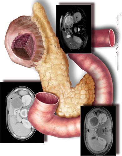 Solid Pseudopapillary Tumor Of The Pancreas Radiographics
