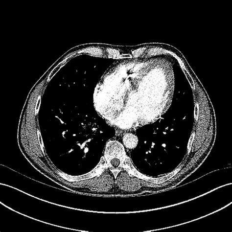 Compilation Of Chest Ct Scans Thorax Cts