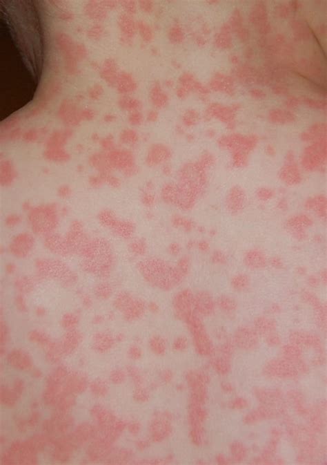 Plexus Allergic Skin Reaction A Online Health Magazine For Daily