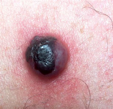 Cherry angiomas are usually painless and not harmful. Hemangioma as related to Cherry angioma - Pictures