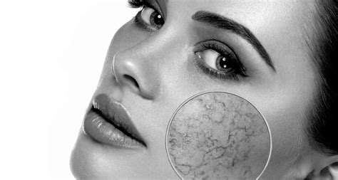 Laser Vein Removal Treatment Ottawa Dermis Advanced Skin Care