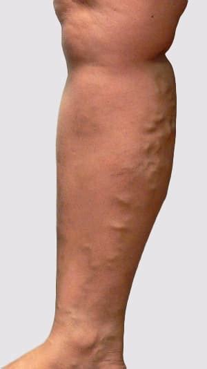 Varicose Veins Types Explained
