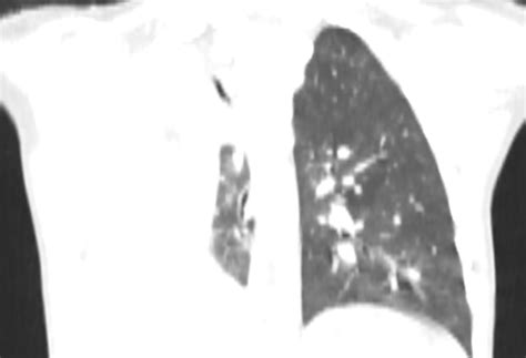 Pulmonary Hypoplasia Image