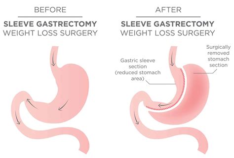 Consent Sleeve Gastrectomy Teachmesurgery