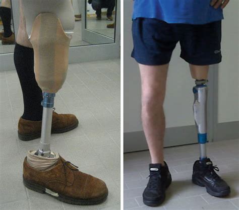 Example Of Transtibial Left And Transfemoral Right Prosthesis