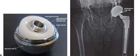 Cementless Acetabular Components For Revision Total Hip Arthroplasty