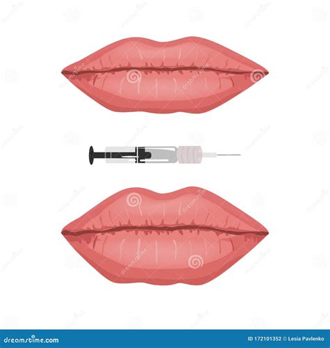 Female Lips Before And After Filler Injections Vector Infographic