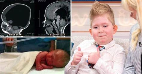 Boy Born With No Brain Proves Miracles Exist After Brain Grows To 80