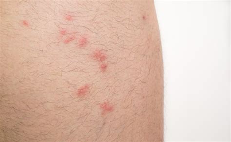 What Are The Symptoms Of An Allergic Reaction To A Bed Bug Bite