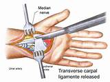 Photos of What Type Of Doctor Does Carpal Tunnel Surgery