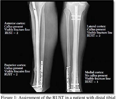 Pdf Reliability Of Radiographic Union Scale In Tibial Fractures And My Xxx Hot Girl