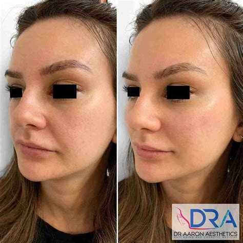 Dermal Fillers Archives Dr Aaron Stanes Anti Ageing And Cosmetic