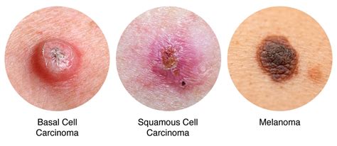 Signs And Symptoms Of Skin Cancer Identify Them In Time