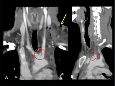 Aortic Arch Pseudoaneurysm Coronal A And Sagittal B Contrast