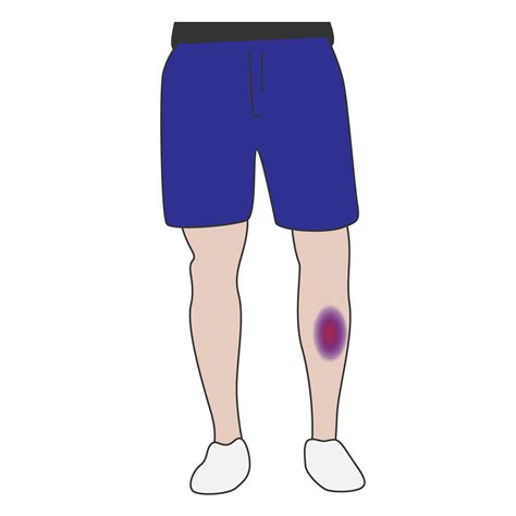 Download 20 Bruise Png