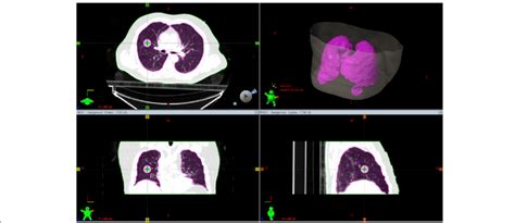 Lung cancer is one of the most deadly cancers, so your care for clients with lung cancer is vital. Example of a digital lung cancer phantom. The pink contour ...