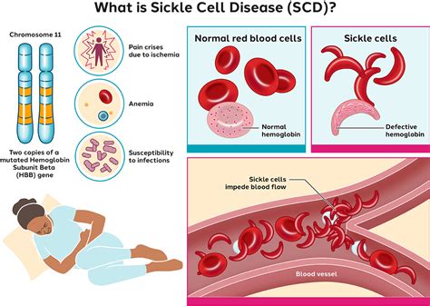 Sickle Cell Anemia Mutation