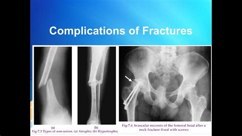 Complications Of Fracture Youtube