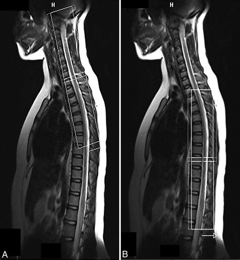 Diffusion Tensor Imaging Of The Normal Cervical And Thoracic Pediatric