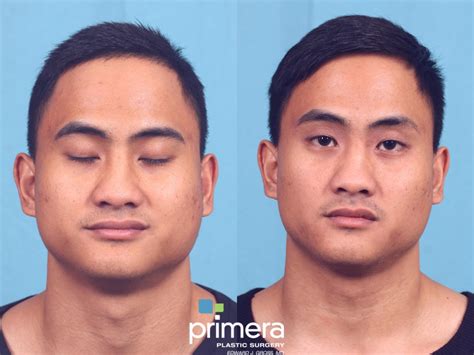 Buccal Fat Removal Before And After Pictures Case 675 Orlando