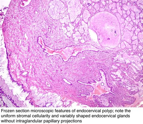 Pathology Outlines Endocervical Polyp