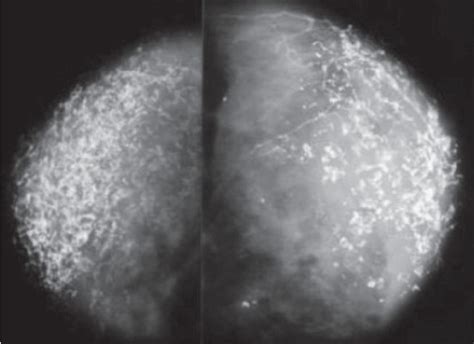 Mammography Shows Unusual And Diagnostic Calcifications Download Scientific Diagram