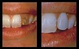 Silver Crowns Teeth Cost Images