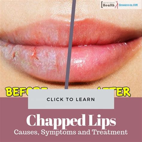 Chapped Lips Causes Picture Symptoms And Treatment