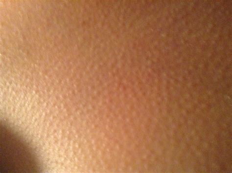 Skin Problems Board Index Little Bumps Like Goosebumps On Chest Area