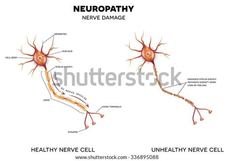 Neuropathy That Damage Nerves This Can Stock Illustration 336895088