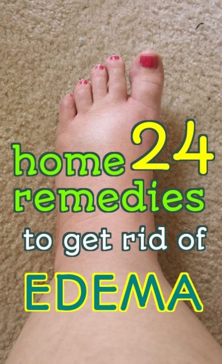 Home Remedy Hacks • 24 Effective Home Remedies To Treat Edema