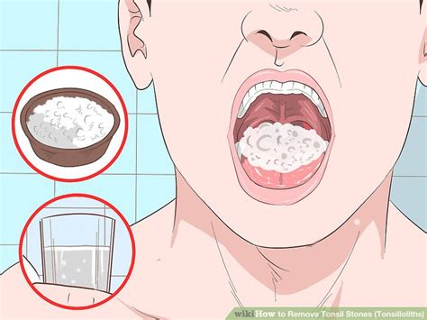 4 Ways To Remove Tonsil Stones Tonsilloliths Wikihow