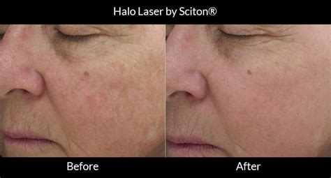 Halo Laser By Sciton® Remington Aesthetics And Cosmetic Surgery