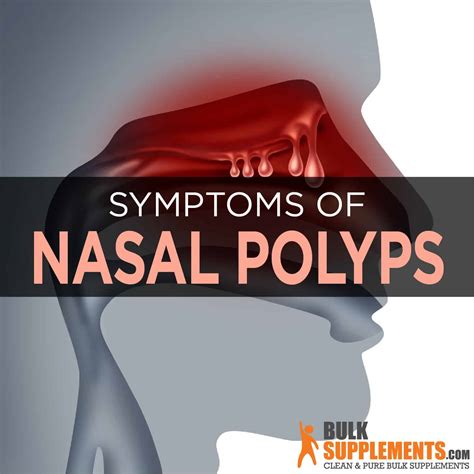 Nasal Polyps Symptoms Causes And Treatment